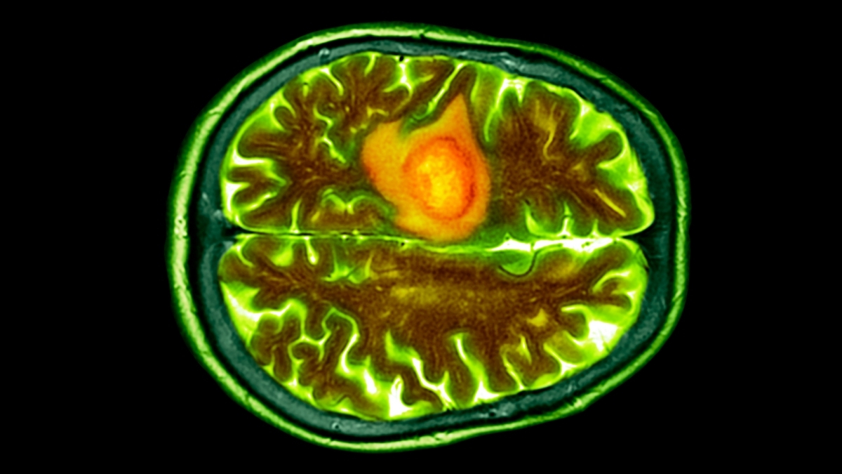 Nasal Drops Could Help Fight a Common And Deadly Brain Cancer : ScienceAlert