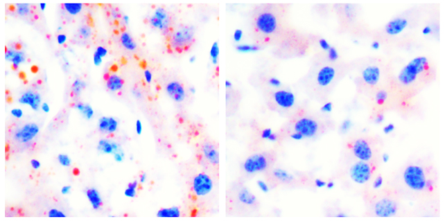 Liver disease picture