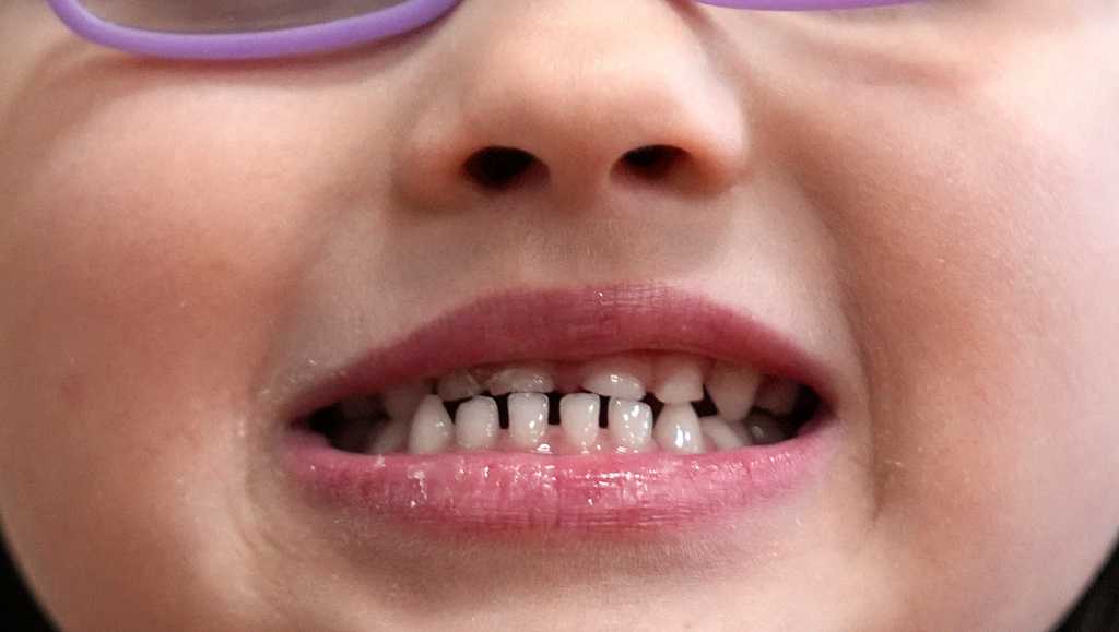 FDA restricts fluoride supplements for children