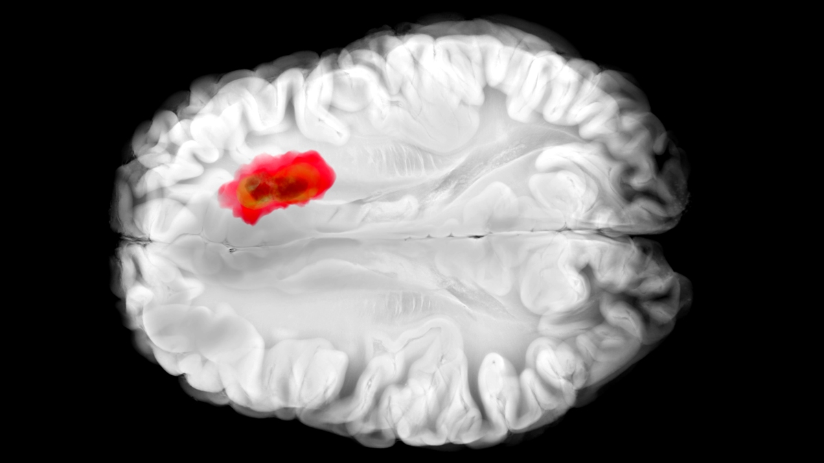 This Common Drug Seems to Fight One of The Deadliest Brain Cancers : ScienceAlert