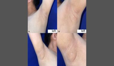 Woman With Rare Condition Has Armpits That Leak Milk