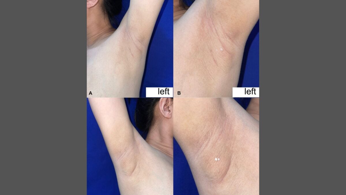 Woman With Rare Condition Has Armpits That Leak Milk