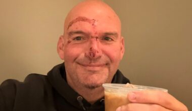 Sen. John Fetterman posts picture of injured face after fall – NBC10 Philadelphia