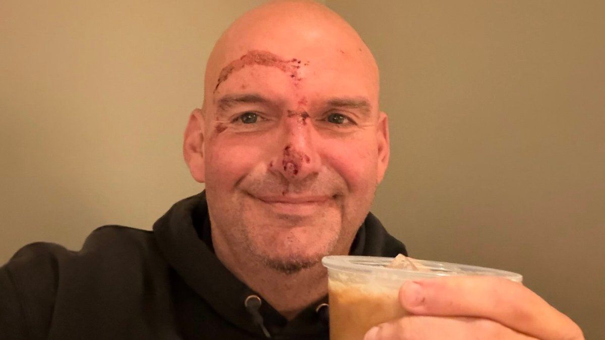 Sen. John Fetterman posts picture of injured face after fall – NBC10 Philadelphia