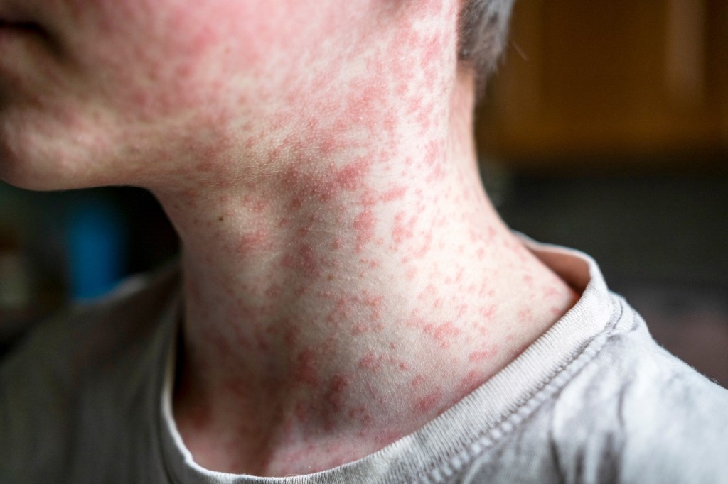Measles rash