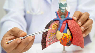 World’s first lung cancer prevention vaccine trial funded with £2.06 million to stop cancer before it starts