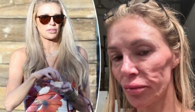 Brandi Glanville says she finally received diagnosis for face disfigurement