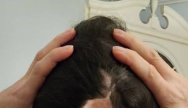 The Link Between My Cancer Surgery & Years Of Neck Pain