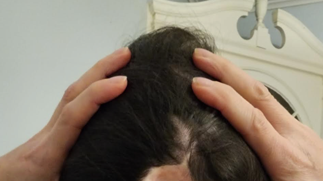 The Link Between My Cancer Surgery & Years Of Neck Pain