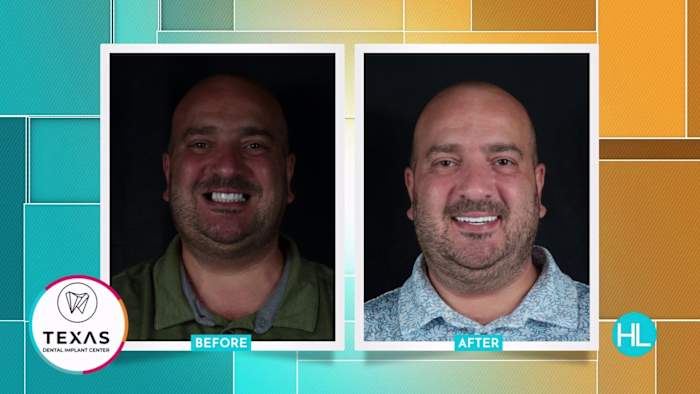 How AI and OneArch are changing full-mouth restorations in Houston