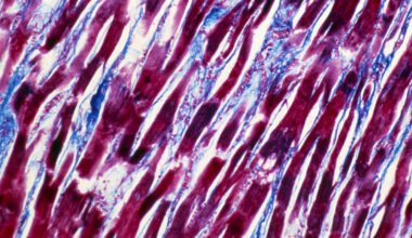 Cause of very rare Covid vaccine side effect, myocarditis, identified