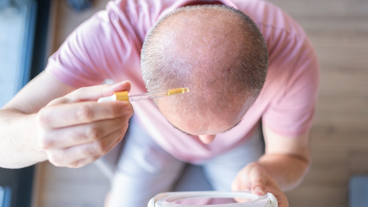 man applies serum with a dropper to the top of his balding head
