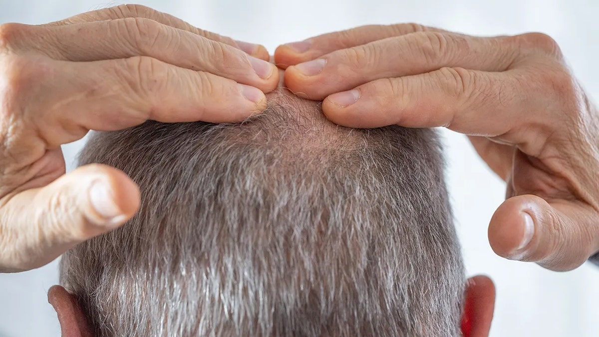 Man touching bald spot on his head
