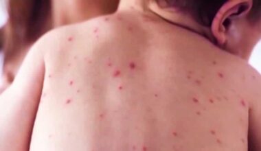 20 new measles cases reported in South Carolina since Friday