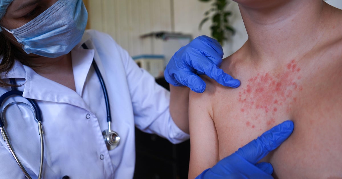 20 more measles cases found in Rockland County, New York, as health leaders urge getting vaccinated
