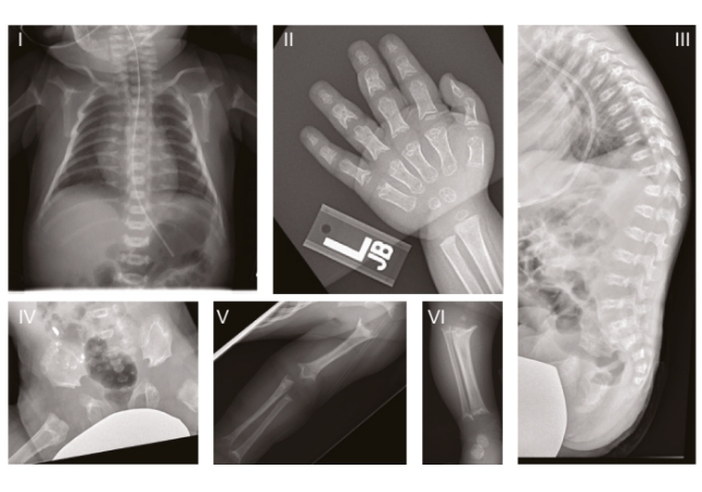 x-rays of a patient with ssmd