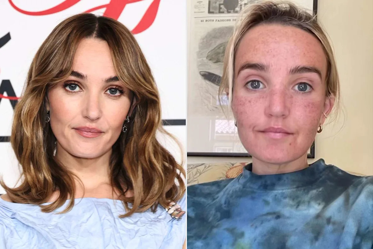 Chloe Fineman Shares 'Botched' iPhone Photos of Cosmetic Procedures
