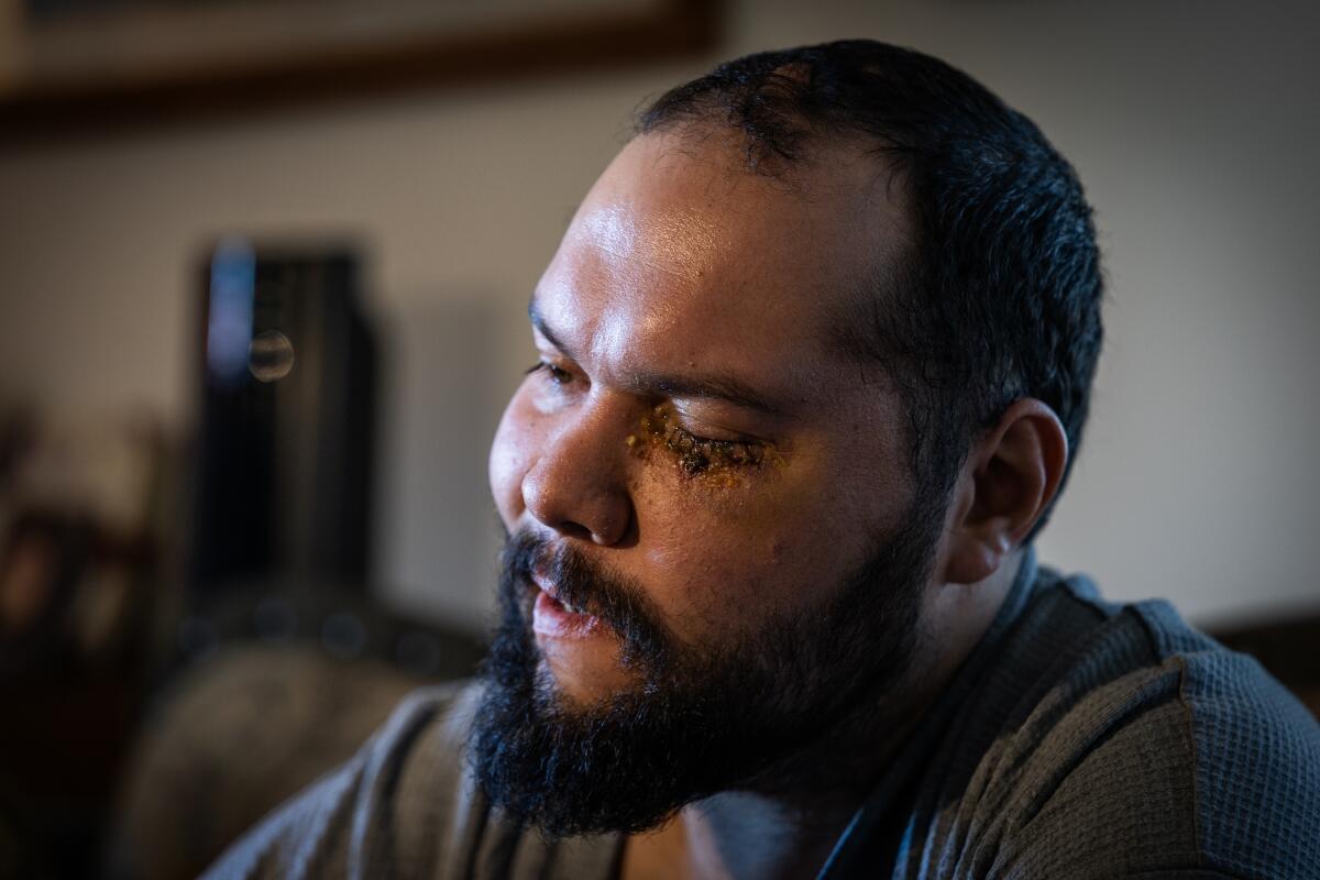 A man recovers at home after being struck in the eye by law enforcement.