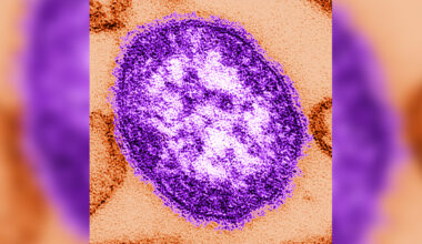 Measles: 2 new cases confirmed in Maricopa County, health officials say