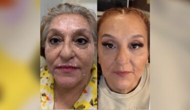 Photo of a woman before and after using Pickture Perfect Medspa services
