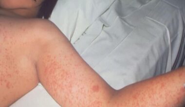 Measles exposure detected in Kentucky after unvaccinated traveler visits Ark Encounter | Local News