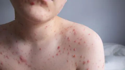 Getty Images Close-up of a spot-covered chest of a young boy with chickenpox - the spots are red and blistered, covering his torso, neck and chin