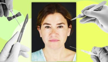 How This Woman in Her Late 40s Got Dramatic Results Without a Facelift