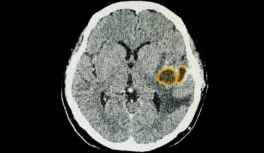 Brain Parasite (illustrative Image)