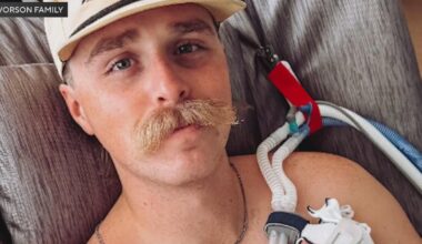 Severely burned Fort Worth firefighter to get workers' comp after outrage over denied care