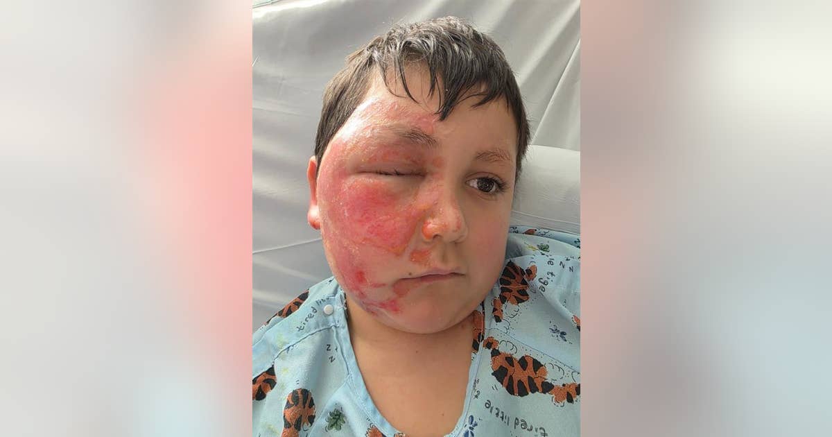 Suburban Chicago boy burned after NeeDoh toy explodes in microwave