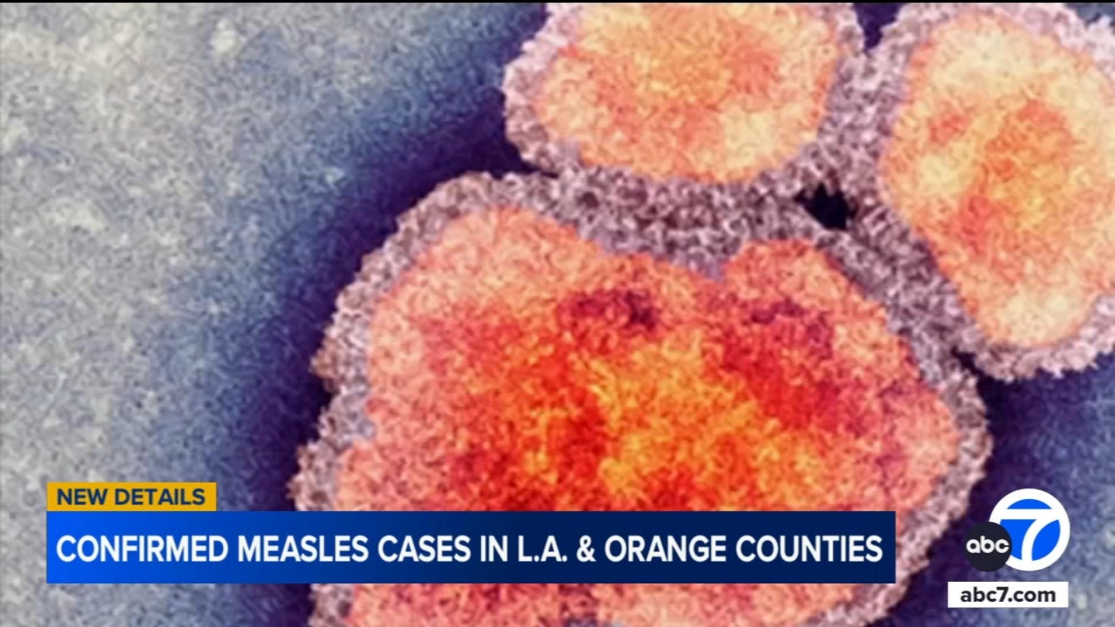Second measles case in Los Angeles County this year confirmed in international traveler