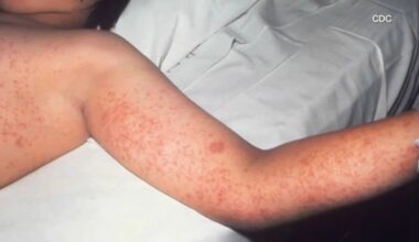 Los Angeles County reports third measles case in the past week; all cases are travel-related