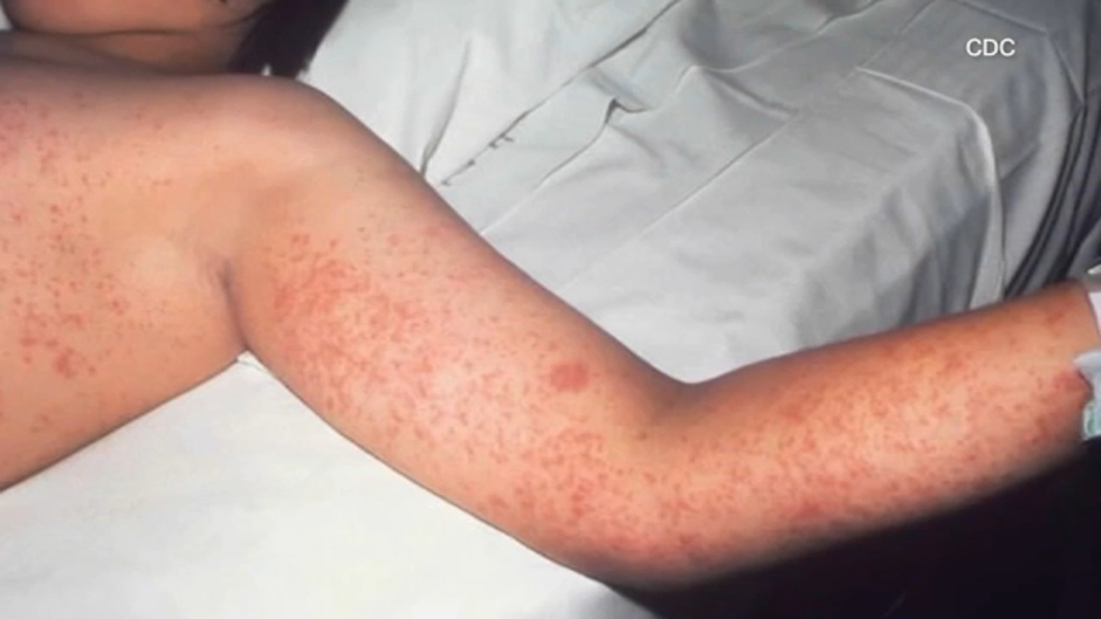 Los Angeles County reports third measles case in the past week; all cases are travel-related