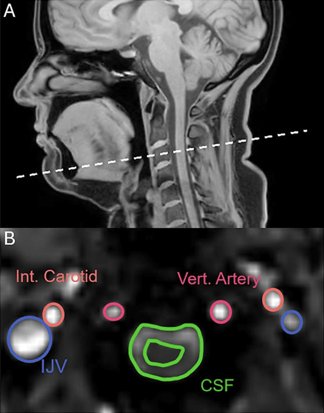 Brain fluid flow