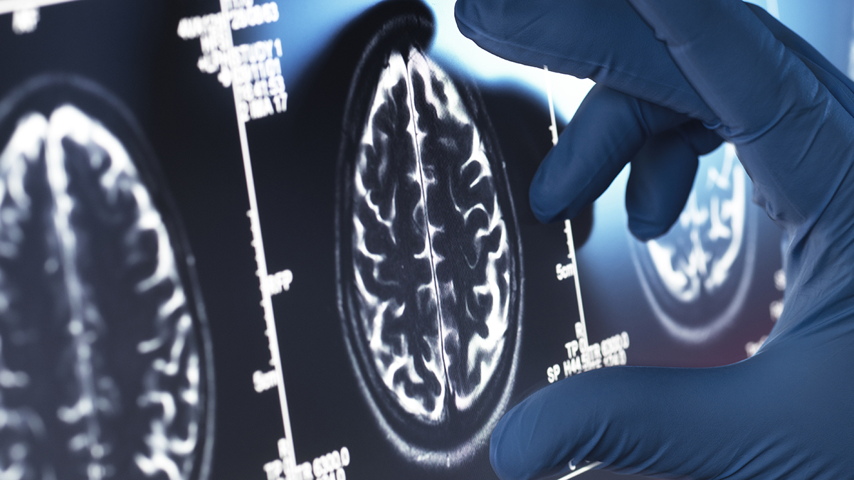 Viagra May Be One of Our Best Existing Options For an Alzheimer's Treatment : ScienceAlert