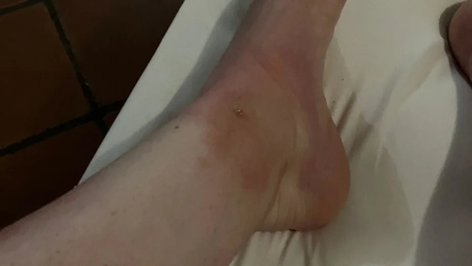 Close up a woman's ankles that look bruised and sore.