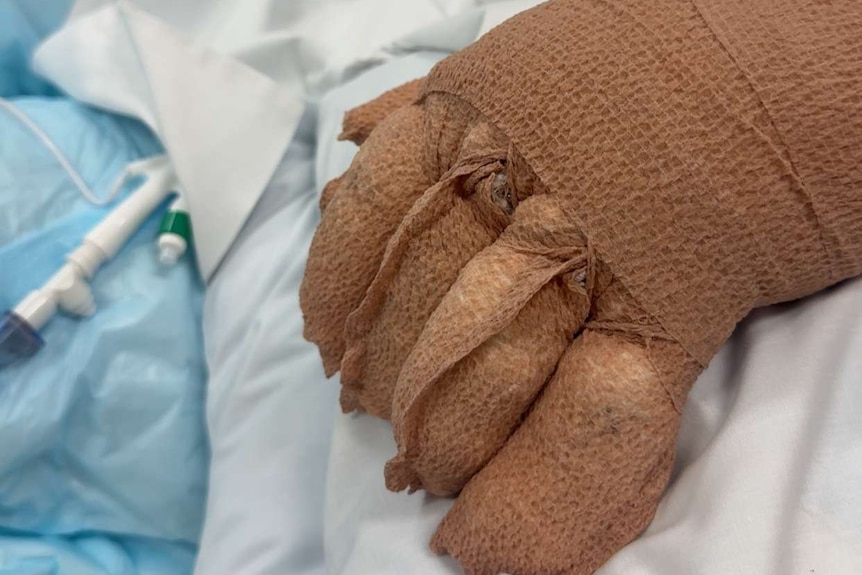 A close up of a bandaged hand