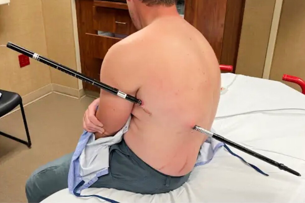 Montana man hikes himself to rescue with pole impaled in his side
