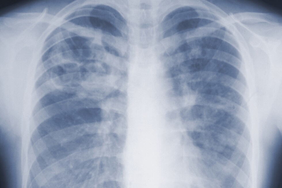 CDC report highlights mold disease, a worry after flooding