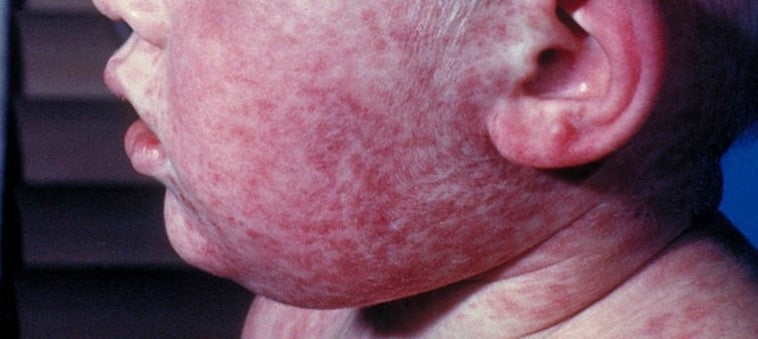 Measles is a nasty virus that can lead to life-threatening brain swelling in children who are unvaccinated. Distrust in vaccines has been at the heart of America’s measles resurgence, with vaccine skepticism rising 15 percent since 2019