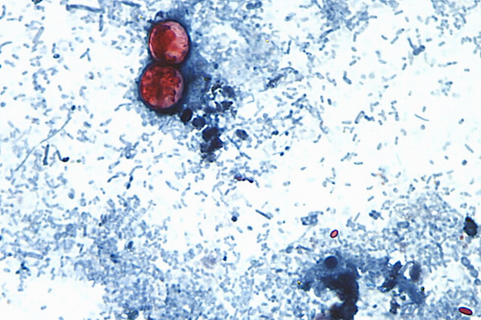 Cyclospora outbreak tied to lettuce now involves 20 US states