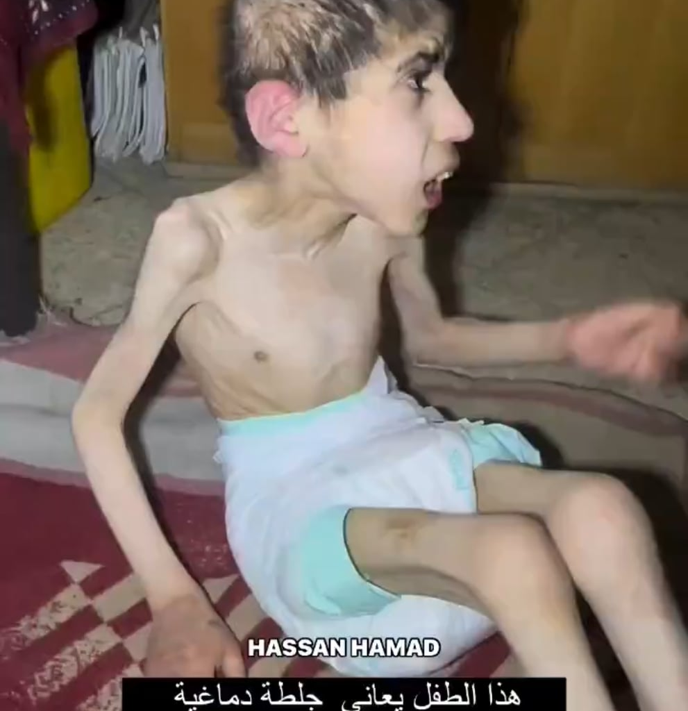 Cet enfant à Gaza souffre d'un accident vasculaire cérébral aggravé par la malnutrition et le manque de soins. Déjà 26 enfants sont morts par la famine imposée par Israël