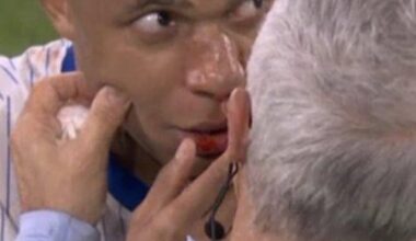 Mbappé suffered a broken nose in the match against Austria
