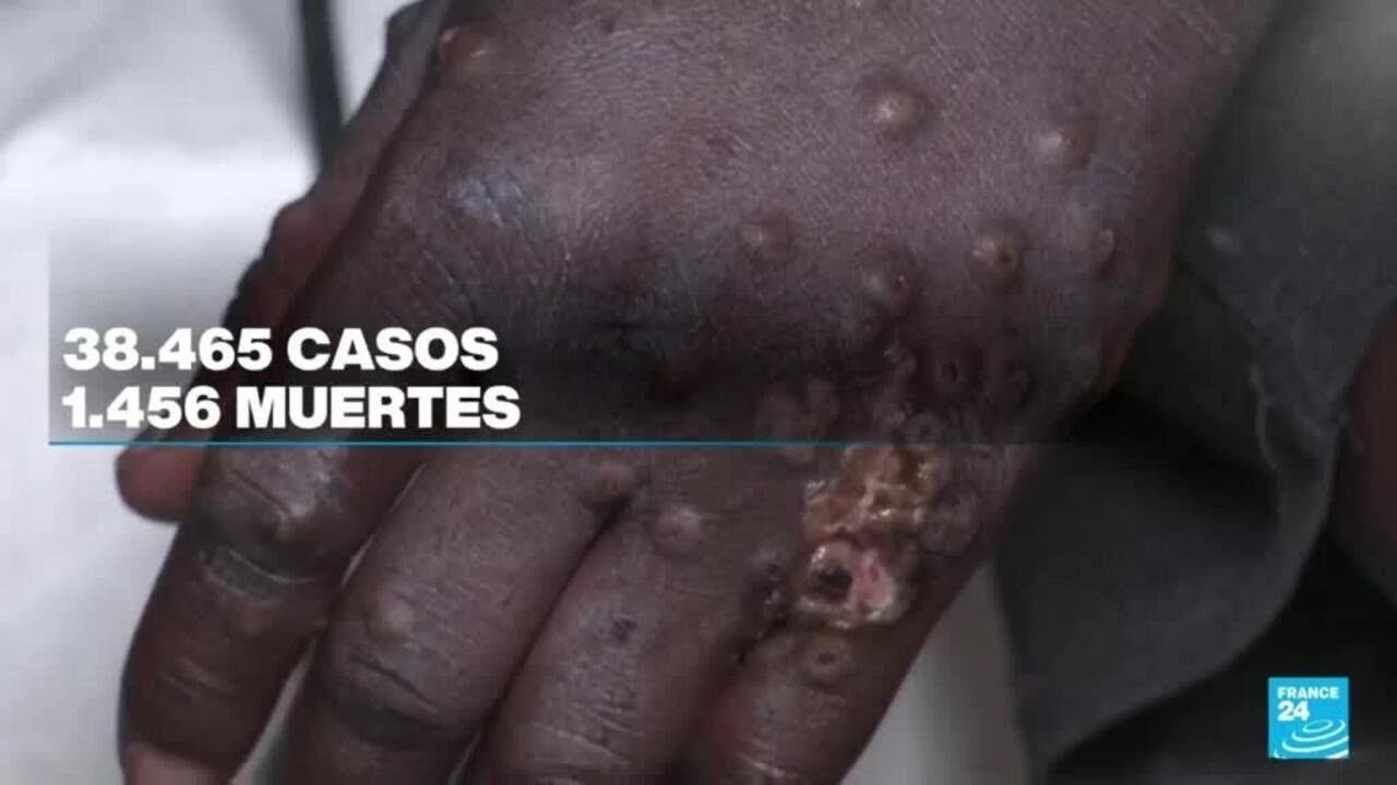 Emergencia en África por celeridad de contagios de viruela del mono • FRANCE 24 Español