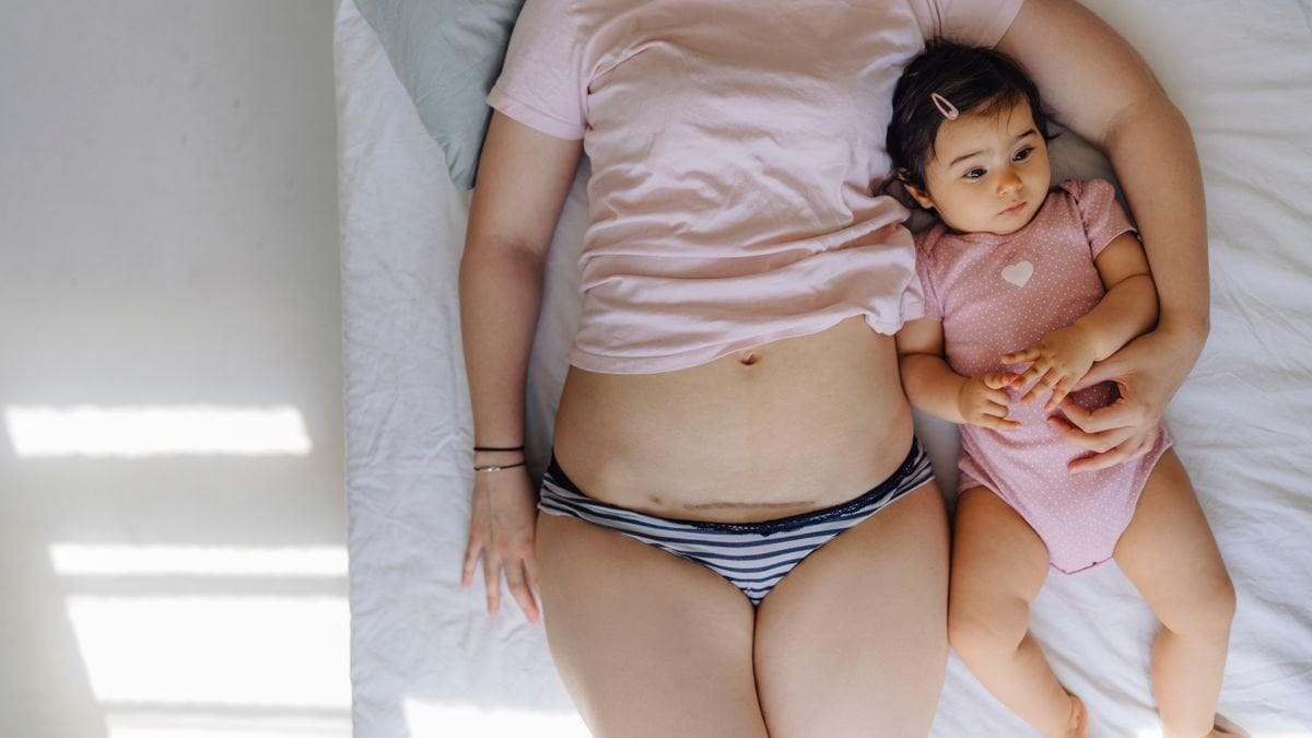 Kaiserschnitte: Welche Folgen haben sie für die Mütter?