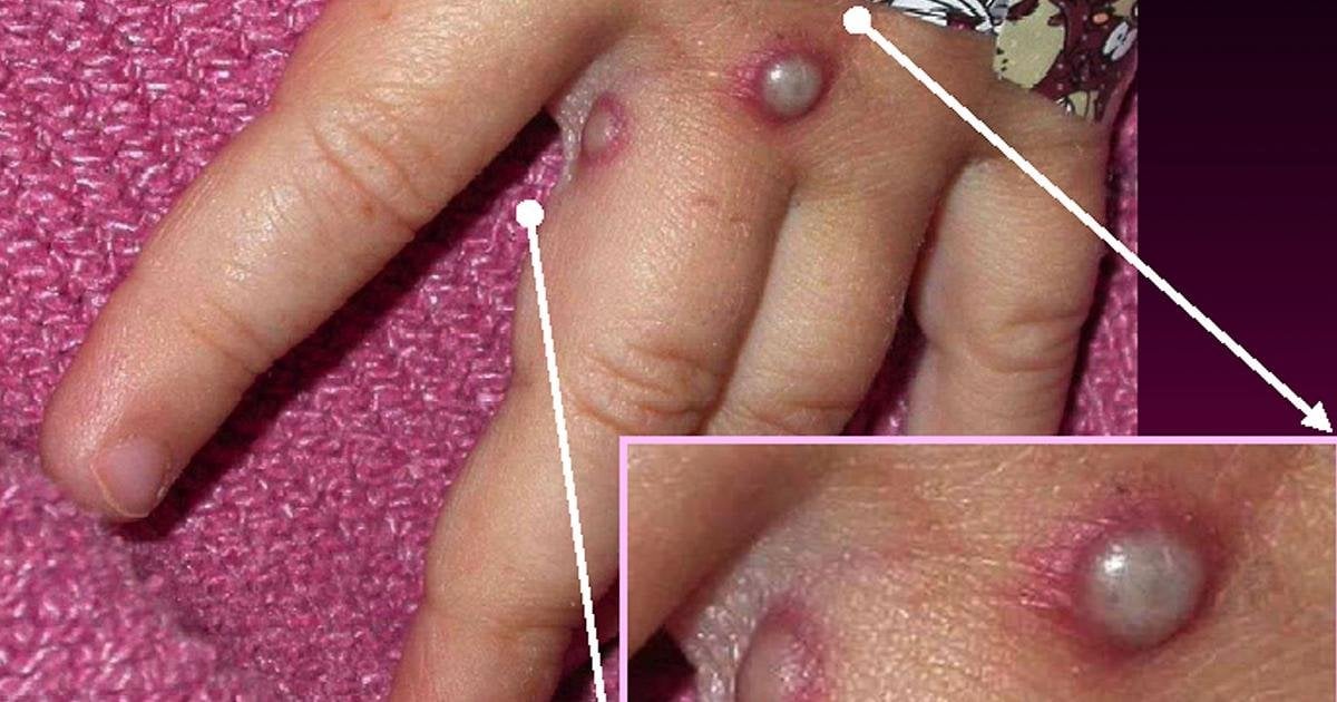 Vaiolo delle scimmie, in Svezia primo caso della variante Clade 1 in Europa