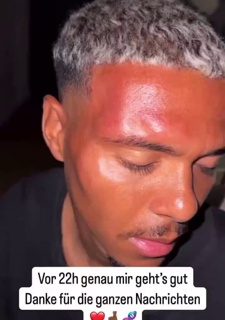 Niklas Wilson-Sommer zeigt seine Verletzungen in seiner Instagram-Story.