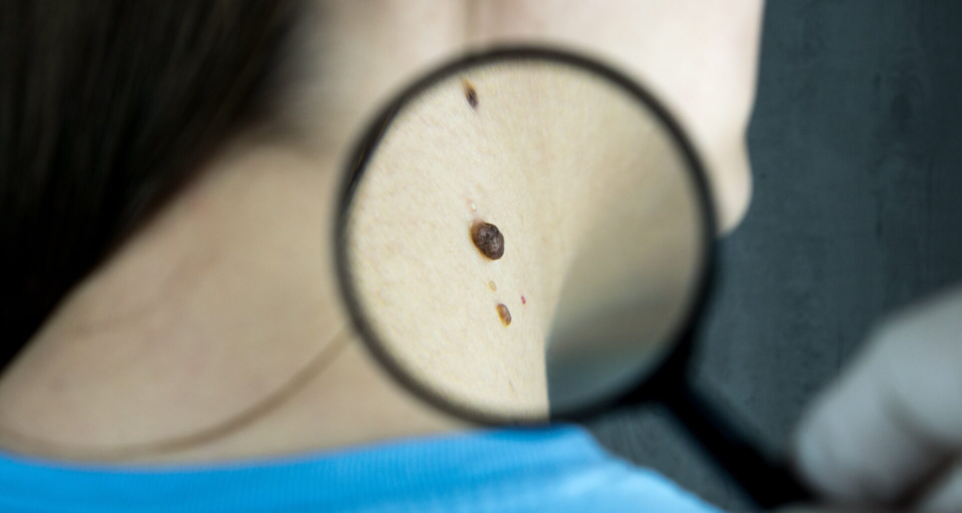 Norway study finds incidence of thin melanoma is increasing faster than that of other kinds