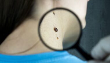 Norway study finds incidence of thin melanoma is increasing faster than that of other kinds