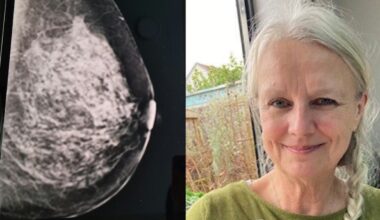 AI Detected Her Early Breast Cancer After Annual Test Came Back as Normal: ‘I feel so lucky’
